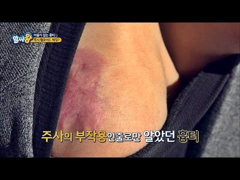 아물지 않는 흉터, 혹시 켈로이드 체질 아니신가요? 알짜왕 5회