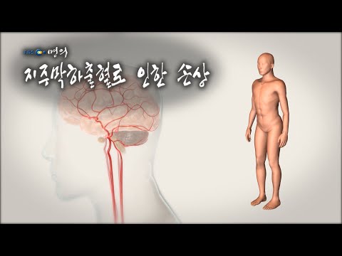 [명의 의학백과📖] 지주막하출혈로 인한 손상